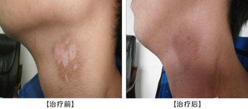 武汉三甲医院治疗白癜风 武汉市儿童医院治疗白癜风好吗