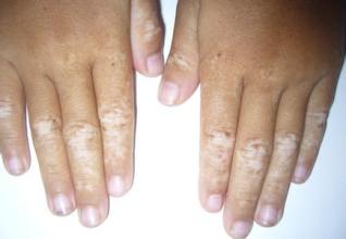 治疗白癜风的有效方法具体有哪些 白癜风治疗的关键在于方法