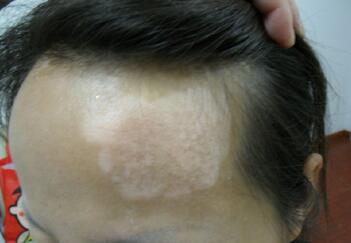 早期的白癜风能治疗吗 小白点点怎么来治疗效果明显