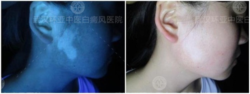 京鄂两地白癜风联合会诊暨隐性白斑公益筛查 京鄂两地白癜风联合会诊暨隐性白斑公益筛查