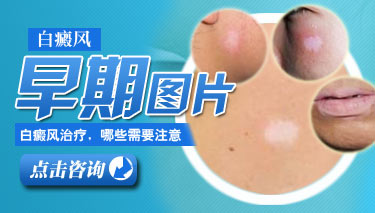 治疗白癜风需要注意什么 儿童白癜风该怎么有效治疗