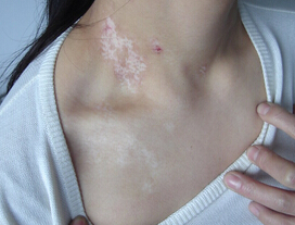 白癜风发病后 应该怎样治疗 治好白癜风疾病需要多久