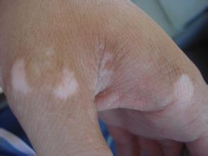 幼儿白癜风能治愈吗 白癜风是否能治愈呢