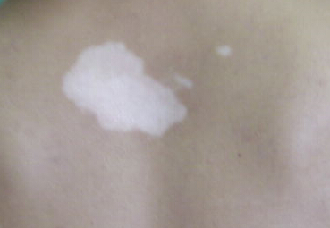 白癜风的原因有什么 青少年白癜风的病因有哪些