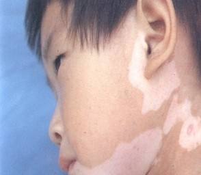 武汉治白斑哪里好答环亚 武汉白斑医院环亚观