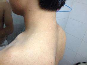 武汉白斑医院环亚导 武汉白斑医院环亚担