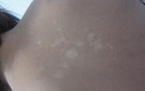 武汉白斑医院讲解白癜风的致病因素是什么? 武汉医生讲述诱发白癜风的因素