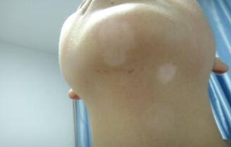 武汉白癜风医院分析中医治疗白癜风的药方 武汉白癜风医院讲解小儿白癜风治疗的措施