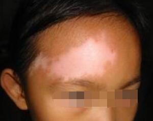 白癜风要如何治疗效果好呢 白癜风治疗没效果怎么办呢