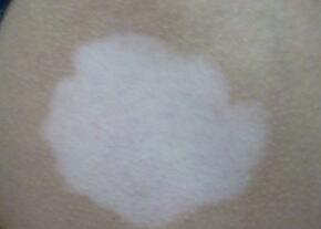 白癜风白斑早期能否去除掉 白癜风病情我们该如何应对