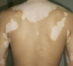 治疗脸部白癜风时应该注意些什么呢? 白癜风治疗方法如何选择效果好?武汉白癜风治疗的医院?