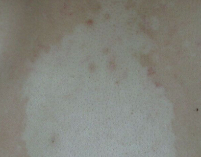 得了白癜风如何处理外伤?武汉治疗白斑较好的医院 烫伤的白癜风为什么早期治疗好?武汉治疗白斑的医院?