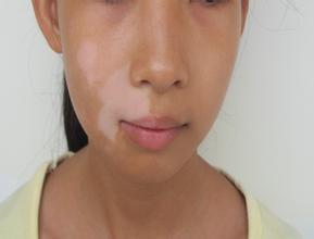 白癜风应该不吃什么食物?武汉哪家治白癜风医院好 吃黑颜色食物有助于缓解白癜风吗?武汉哪家医院治白癜风比较好