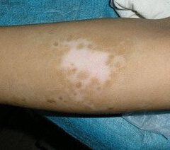 �������ưװ߲��Ϻõ�ҽԺ�����ư���Ͽ�ķ�����ʲô