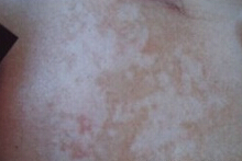 武汉工作期间白癜风患者要注意些什么? 武汉如何做好白癜风的日常护理