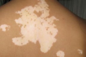 武汉专治白癜风的医院哪家好?预防白癜风扩散有什么好方法? 武汉治白癜风去哪个医院?白癜风预防的关键点有哪些