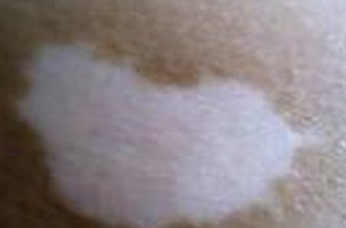 武汉北大白癜风医院讲解治疗白癜风需要注意什么?