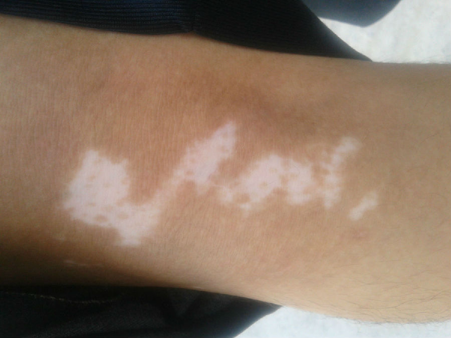 武汉白癜风哪治得好?白癜风治好后有什么要注意的?