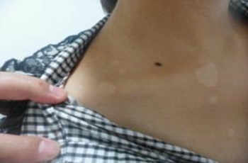 武汉看白癜风正规医院?合理安排饮食习惯有助于白癜风治疗 武汉看白癜风专科医院?白癜风康复后饮食还需要注意吗