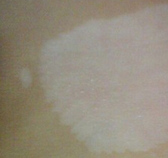 武汉看白斑专科医院?白癜风治好了还会扩散吗 武汉看白斑哪个医院较好?很小的白点是得了白癜风吗