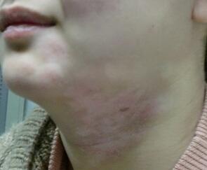 武汉白癜风看哪家医院好?如何预防青少年白癜风 武汉白癜风看哪里较好?如何预防小孩白癜风