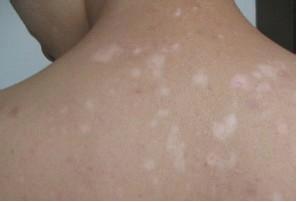 武汉哪家医院可以治白斑?白癜风如何治疗比较好 武汉哪家医院治白斑?白斑病如何使用食疗的办法?