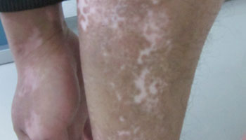 武汉白癜风医院哪家好?治疗皮肤白点 武汉有没有专门治白癜风的医院?应该如何预防白癜风的出现