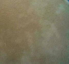 武汉看白癜风的医院?白癜风的预防与调护措施有哪些 武汉看白癜风好吗?生活中该如何预防白癜风