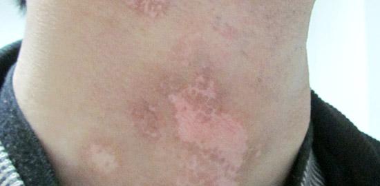 武汉白癜风哪家医院比较好?如何控制白癜风的发作和扩散 武汉白癜风哪家好?白癜风患者怎样保养皮肤呢