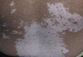 武汉较专业的白癜风医院?武汉白癜风患者饮食上需要如何注意呢? 武汉专业的白癜风医院?武汉白癜风患者应该如何注意饮食呢?