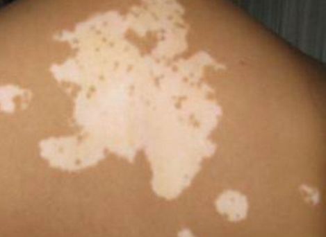 武汉市儿童医院可以治白斑吗?武汉如何能效的治疗白癜风呢?