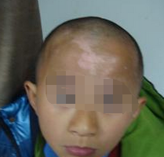 武汉三甲医院治白斑?武汉如何能有效治疗儿童白癜风呢?