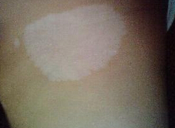 武汉哪个看白癜风医院好?武汉扩散后的白癜风有哪些治疗方法呢? 武汉哪个医院看白癜风较好?武汉白癜风扩散后该如何治疗呢?