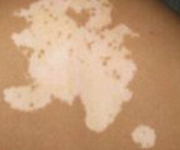 武汉治白癜风疗效好的医院?武汉女性白癜风的病因会有哪些呢? 武汉治白癜风较好的医院?武汉女性白癜风的病因会有哪些呢?